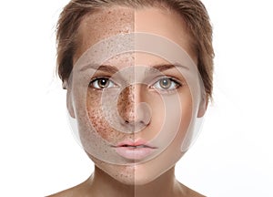 Woman freckle half-face happy young beautiful portrait healthy skin half