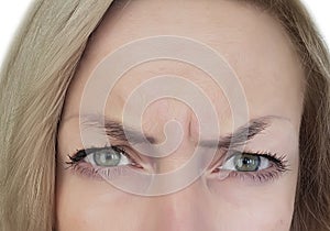 Woman frowns her forehead, wrinkles, botox photo