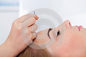 Woman getting acupuncture treatment