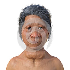 A woman with Graves' disease, 3D illustration
