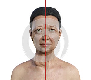 A woman with Graves' disease and the same healthy person, 3D illustration