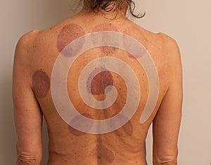 Woman that had Cupping Therapy