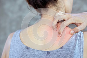 Woman hand scratching her sweat skin itchy because of allergy