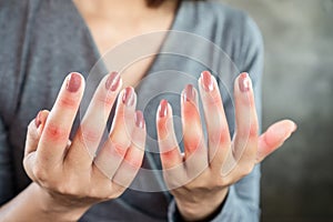 Woman hand suffering from joint pain with gout in finger