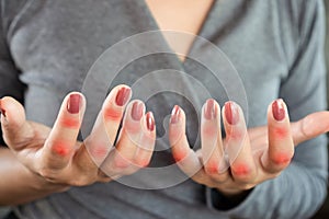 Woman hand suffering from joint pain with gout in finger photo