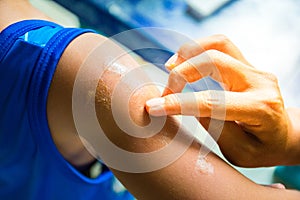 Woman hand to treat the patient`s arm with Ointment mosquito bites