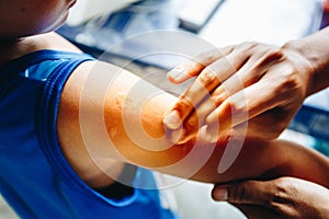 Woman hand to treat the patient`s arm with Ointment mosquito bites