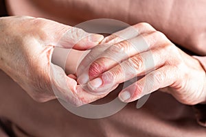 Woman hands with atopic dermatitis, eczema, allergy reaction on skin