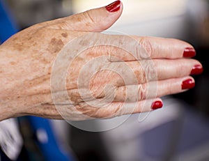 Woman hands with rheumatism arthritis and skin blemishes