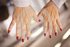 Woman hands with rheumatism arthritis and skin blemishes