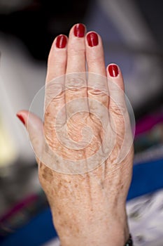 Woman hands with rheumatism arthritis and skin blemishes