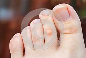 Woman has hard corns and calluses on her toes.