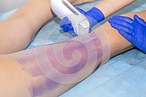 Woman having hair removal procedure on leg with wax depilatory in salon. Depilation concept