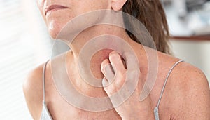 Woman having itchy and scratching her arm