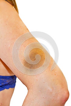 Woman with a hematoma