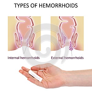 Woman holding suppository for hemorrhoid treatment under illustrations of lower rectum on background