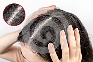 The woman holds her head with her hands, showing a parting of dark hair with dandruff. Close up. The view from the top. Zoomed