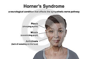 A woman with Horner syndrome, 3D illustration