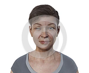 A woman with Horner syndrome, 3D illustration