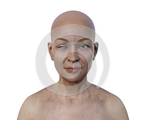 A woman with Horner syndrome, 3D illustration