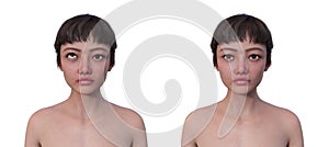 A woman with hypertropia and a healthy person, 3D illustration