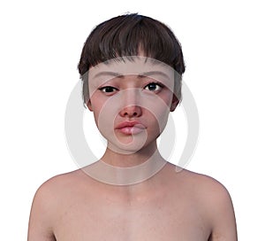 A woman with hypotropia, 3D illustration