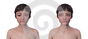 A woman with hypotropia and a healthy person, 3D illustration