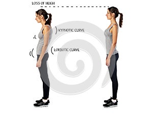 Woman with impaired posture position defect photo