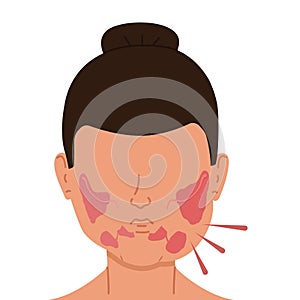 Woman with inflamed salivary glands