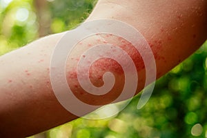 Woman with itching from biting insect in body in tropical jungle forest