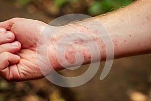 Woman with itching from biting insect in body in tropical jungle forest