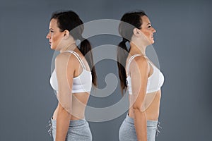 Woman With Kyphosis And Normal Curvature