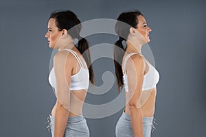 Woman With Kyphosis And Normal Curvature photo