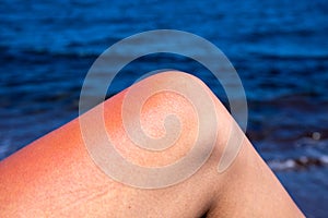 Woman leg with red sunburn skin on blue sea background. Sun burned skin redness and irritation