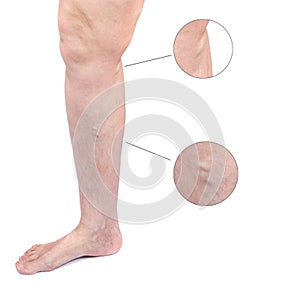 Woman leg with varicose veins isolated on white background. Varicosity spider veins. Medicine and cosmetology