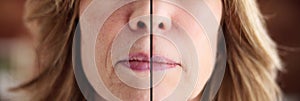 Woman lifting skin after wrinkle face treatment