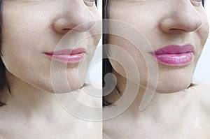 Woman  lips before and after augmentation difference  injection