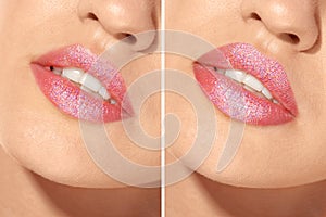 Woman before and after lips augmentation procedure