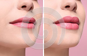 Woman before and after lips augmentation procedure