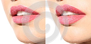 Woman before and after lips augmentation procedure