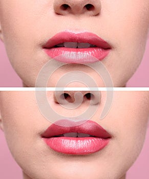 Woman before and after lips augmentation procedure