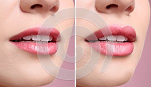 Woman before and after lips augmentation procedure