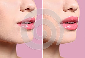 Woman before and after lips augmentation procedure on color background