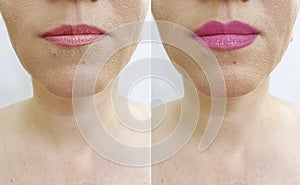 Woman lips before after augmentation shape effect