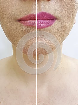 Woman lips before  after augmentation shape effect