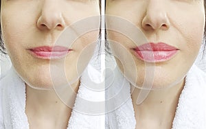 Woman lips before and after correction augmentation difference injection