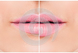 Una donna labbra Prima un dopo il bordo mastice iniezione 