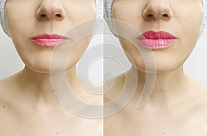 Woman lips before and after perfect enhancement correction augmentation difference injection photo