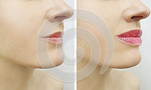 Woman lips before and after perfect therapy enhancement correction augmentation difference injection