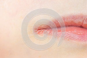 Woman lips skin with Herpes Labialis virus close up.
